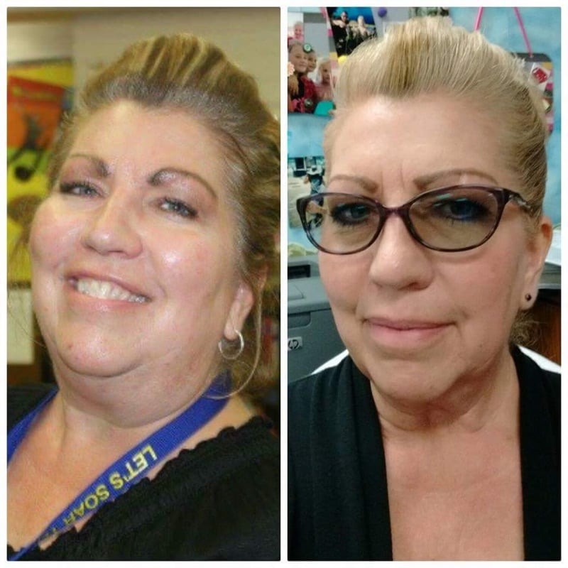 before after of thyroid patient