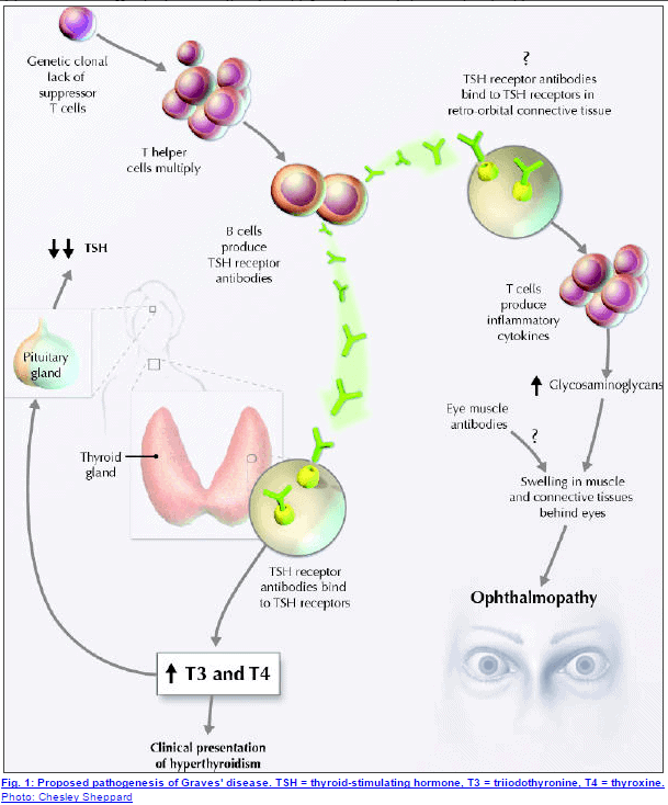 a schematic showing how graves' disease starts and impacts various tissues in the body.
