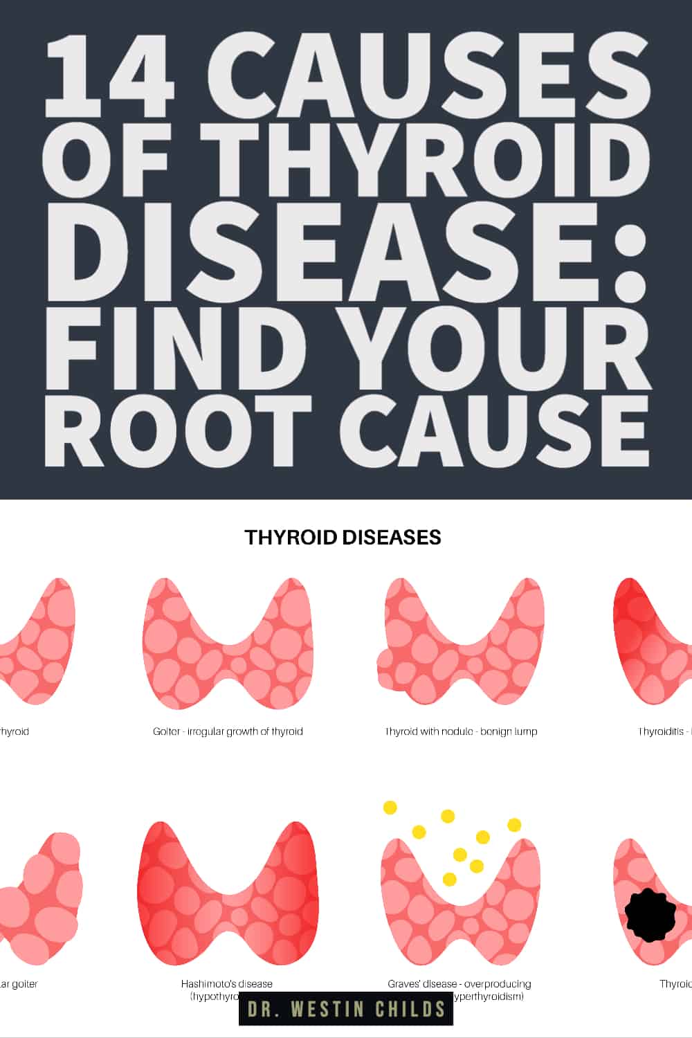 14 causes of thyroid disease: find your root cause