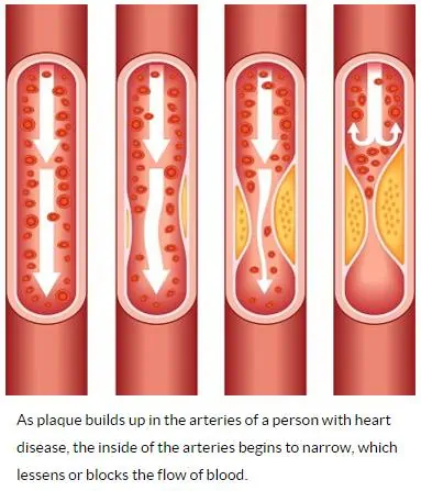 image outlining how cholesterol impacts arteries