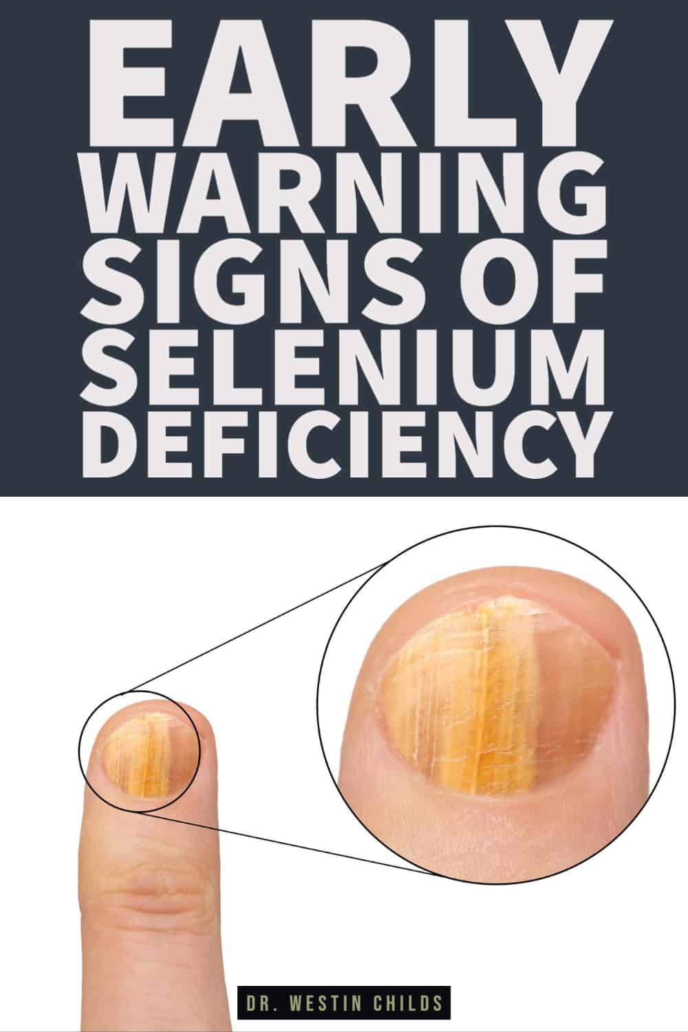 signs that you may be selenium deficient signs that you may be selenium deficient