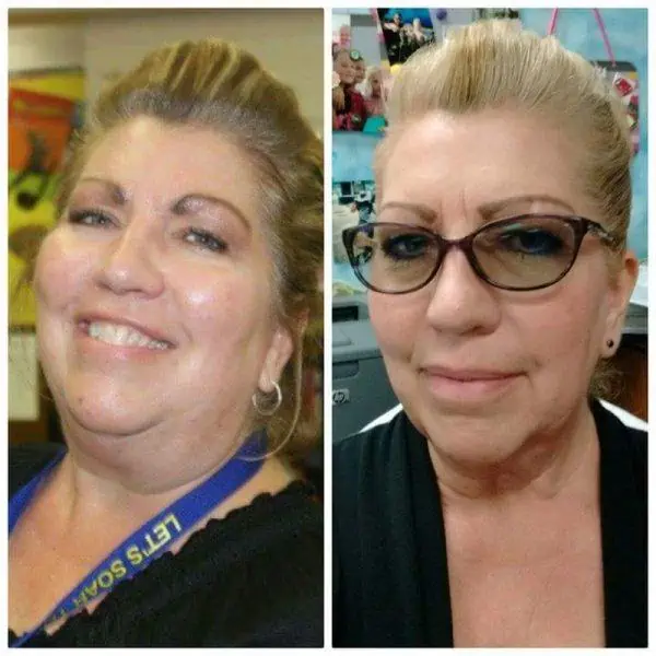 28kg weight loss with Hypothyroidism (pics included) —