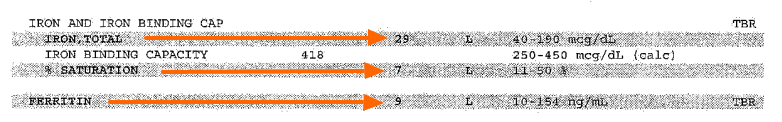 iron lab studies from a patient showing low total iron, low % saturation, and low ferritin levels. 