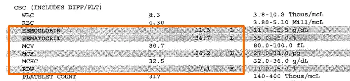 lab results from a patient with low iron highlighting the impact that low iron has on the CBC including its impact on hgb, hct, MCV, MCH, MCHC, and RDW. 