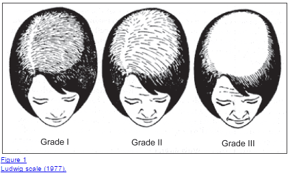 a schematic showing grade 1, grade 2, and grade 3 hair loss in a woman. 