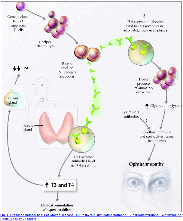 a schematic showing how graves' disease starts and impacts various tissues in the body. 