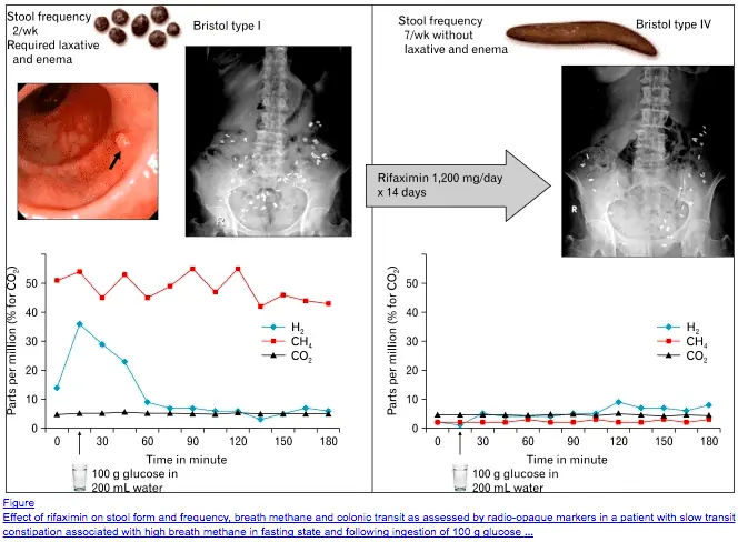 constipation in SIBO patients