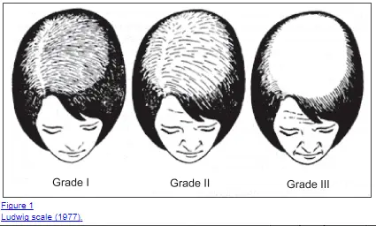 male pattern baldness in women