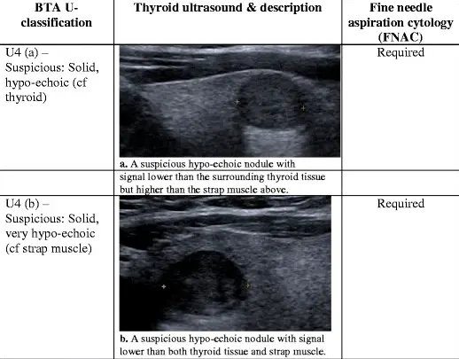 Example of thyroid cysts on ultrasound imaging which require FNA