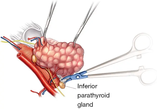 picture of the parathyroid gland in relationship to the thyroid gland