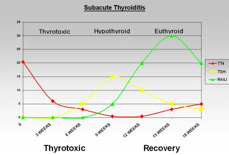 thyroid lab tests overtime with subacute thyroiditis