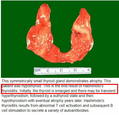 end stage hashimoto's causes destruction of the thyroid gland