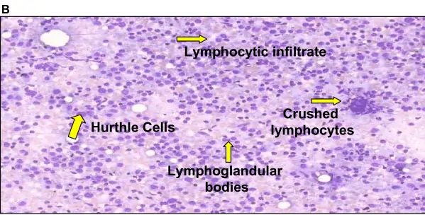 How to Diagnose Hashimoto's Thyroiditis with Lab Tests