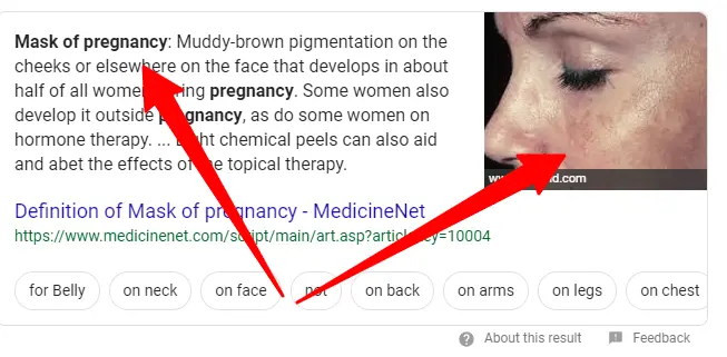 melasma is a potential side effect of birth control pills melasma is a potential side effect of birth control pills