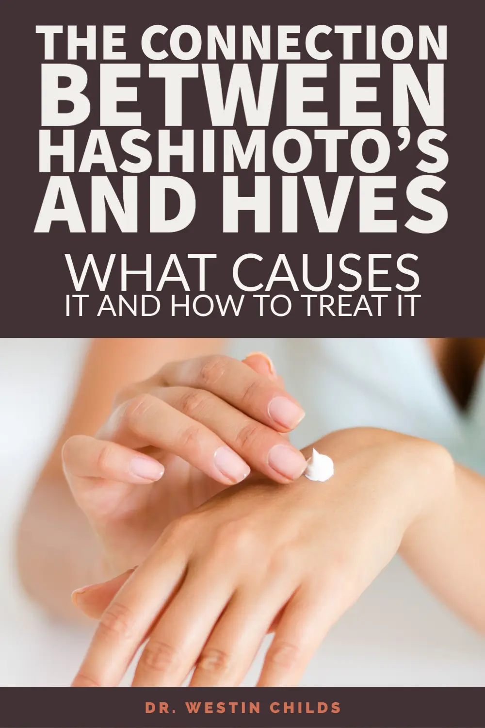 Why Hashimoto's Causes Hives and What it Means for your Immune System Why Hashimoto's Causes Hives and What it Means for your Immune System