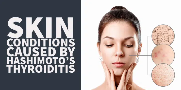 15 Skin Conditions Caused By Hashimoto's Thyroiditis