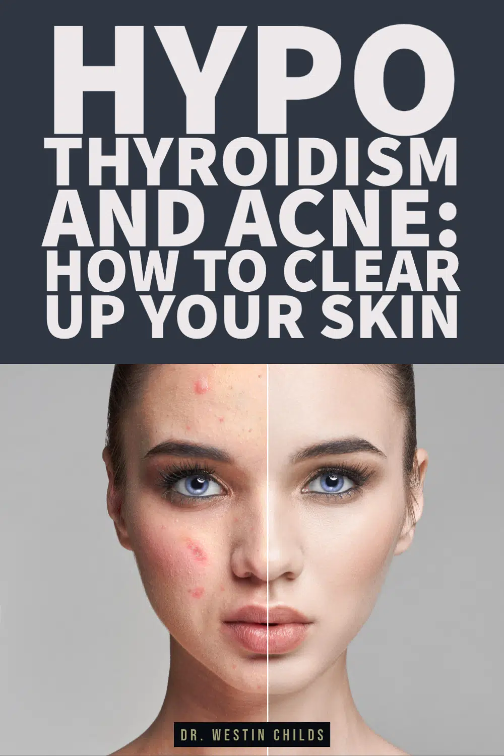 how low thyroid causes acne pinterest image. 