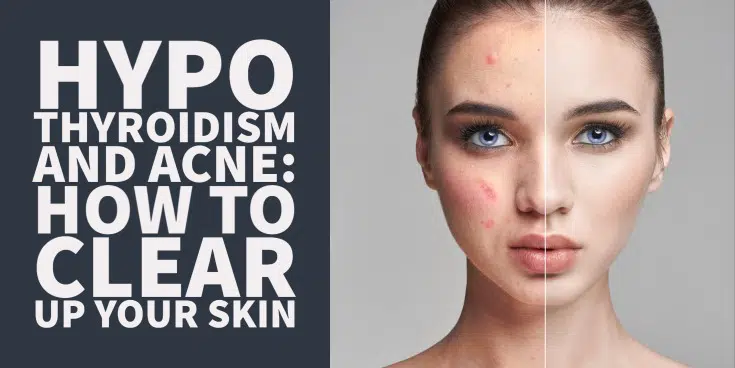 Hypothyroidism and acne