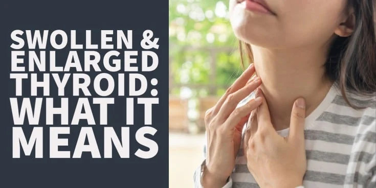 Swollen and enlarged thyroid: What it means and what causes it