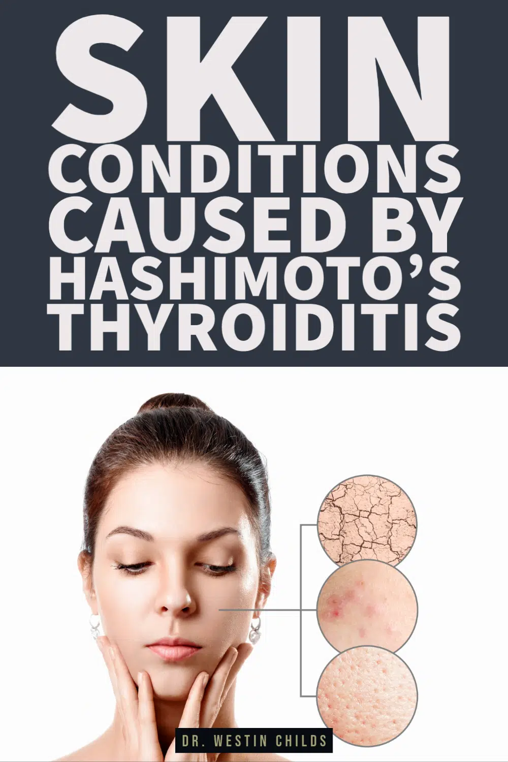 these skin conditions are caused by hashimoto's thyroiditis