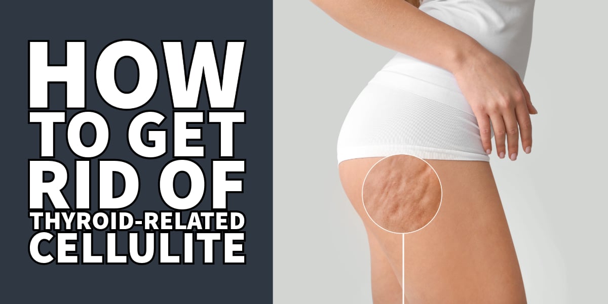 How To Get Rid of Thyroid-Related Cellulite