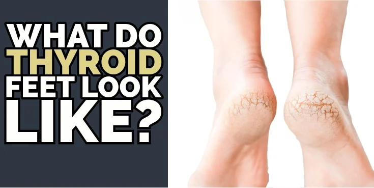 what do thyroid feet look like